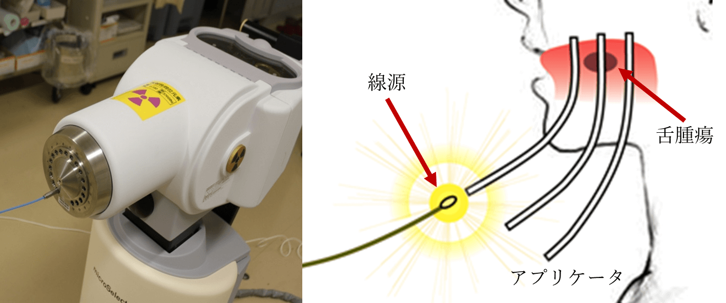 小線源療法の目的は何ですか?